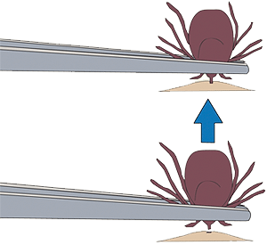 إزالة القراد